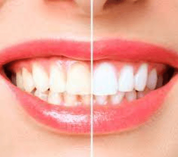 Dull to Dazzling: Maple Ridge Teeth Whitening Magic