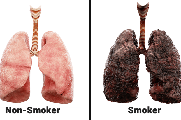 The Devastating Impact of Smoking on Lung Health