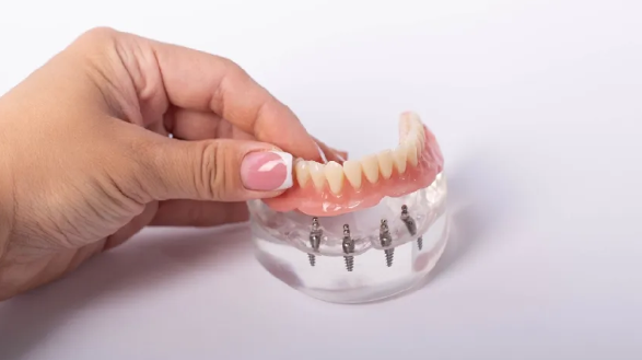 Complete Guide to All-On-4 Dental Implants