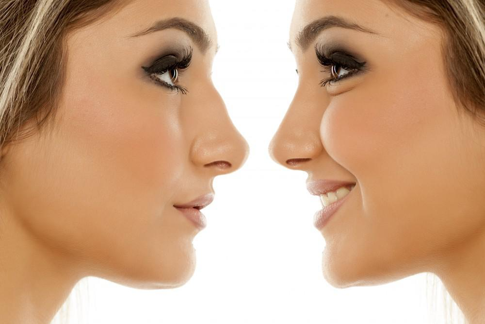 The Benefits and Considerations of Nose Surgery