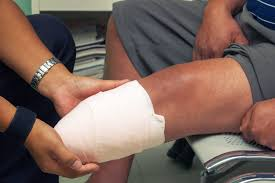 Common Causes of Amputation Injuries in Workplace Accidents