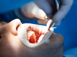 The Role of Osseous Surgery in Kansas City To Help Stop Periodontal Disease